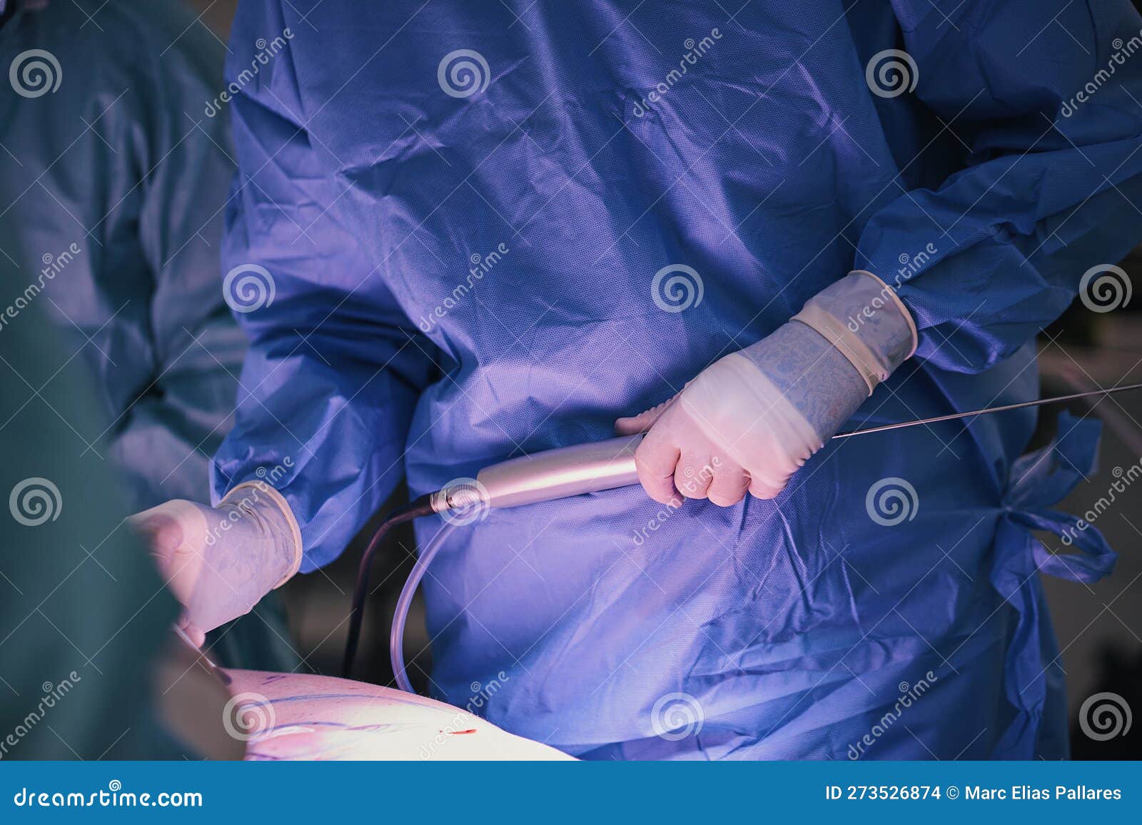 High Definition Liposuction in the Operating Room Stock Photo Image of equipment, instrument