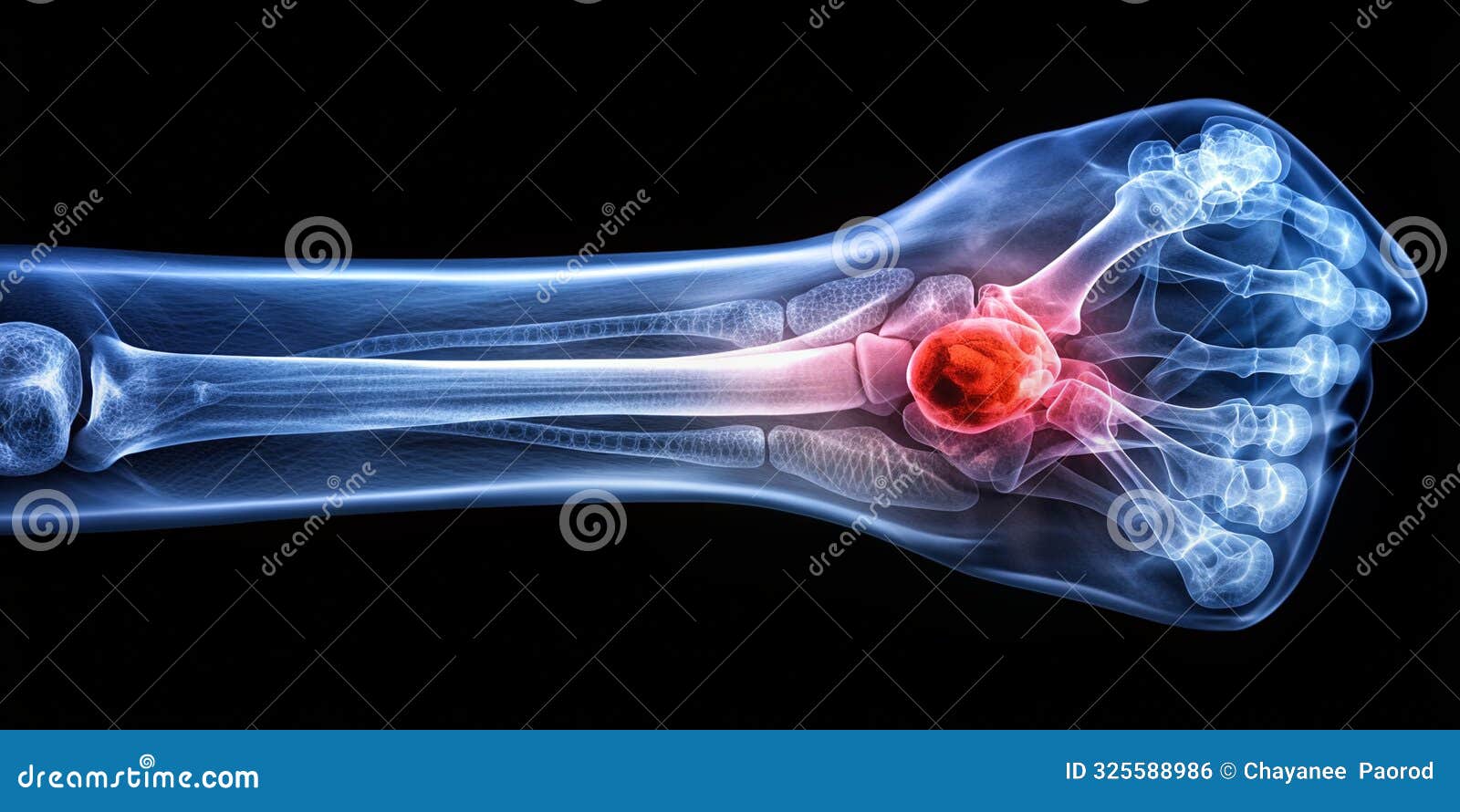 high resolution x ray showing a lytic lesion in the bone indicative of bone cancer ai-created content