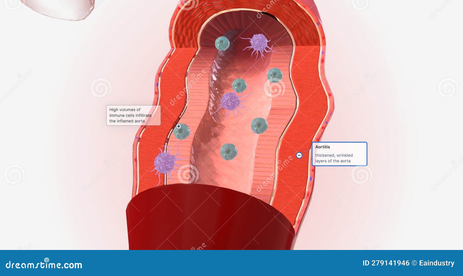 High Volumes of Lymphocytes, Macrophages, and Other Immune Cells ...