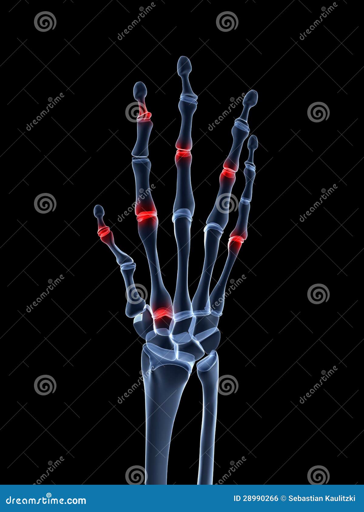 Highlighted arthritic hand stock illustration. Illustration of human