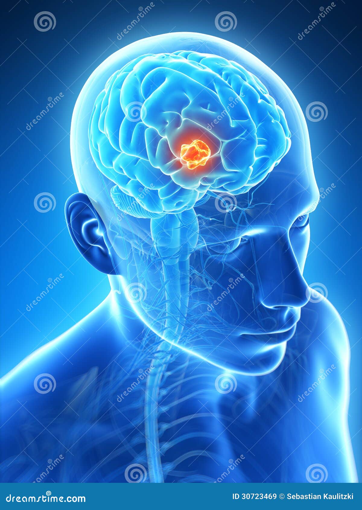 highlighted brain tumor