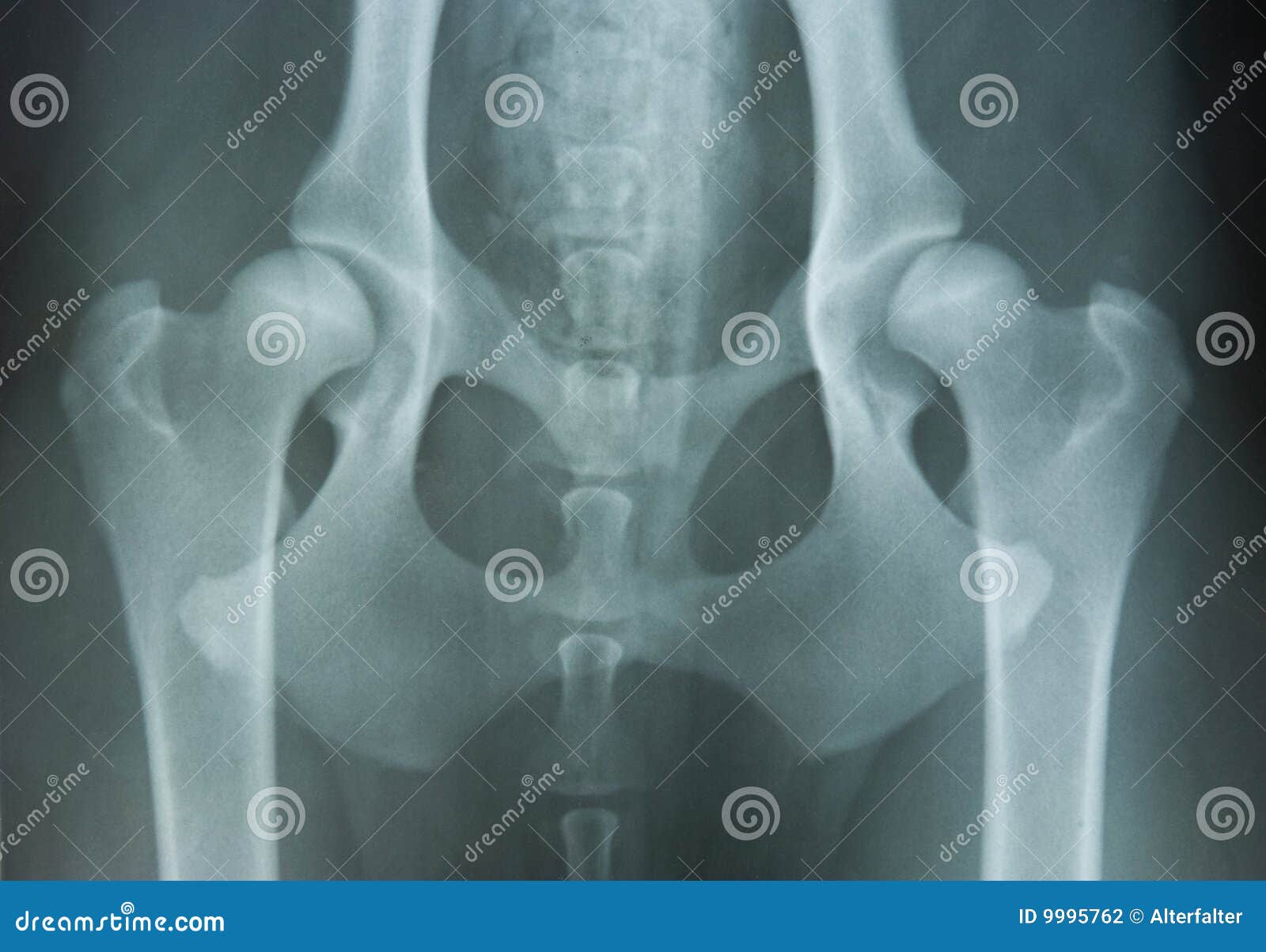 hip dysplasia