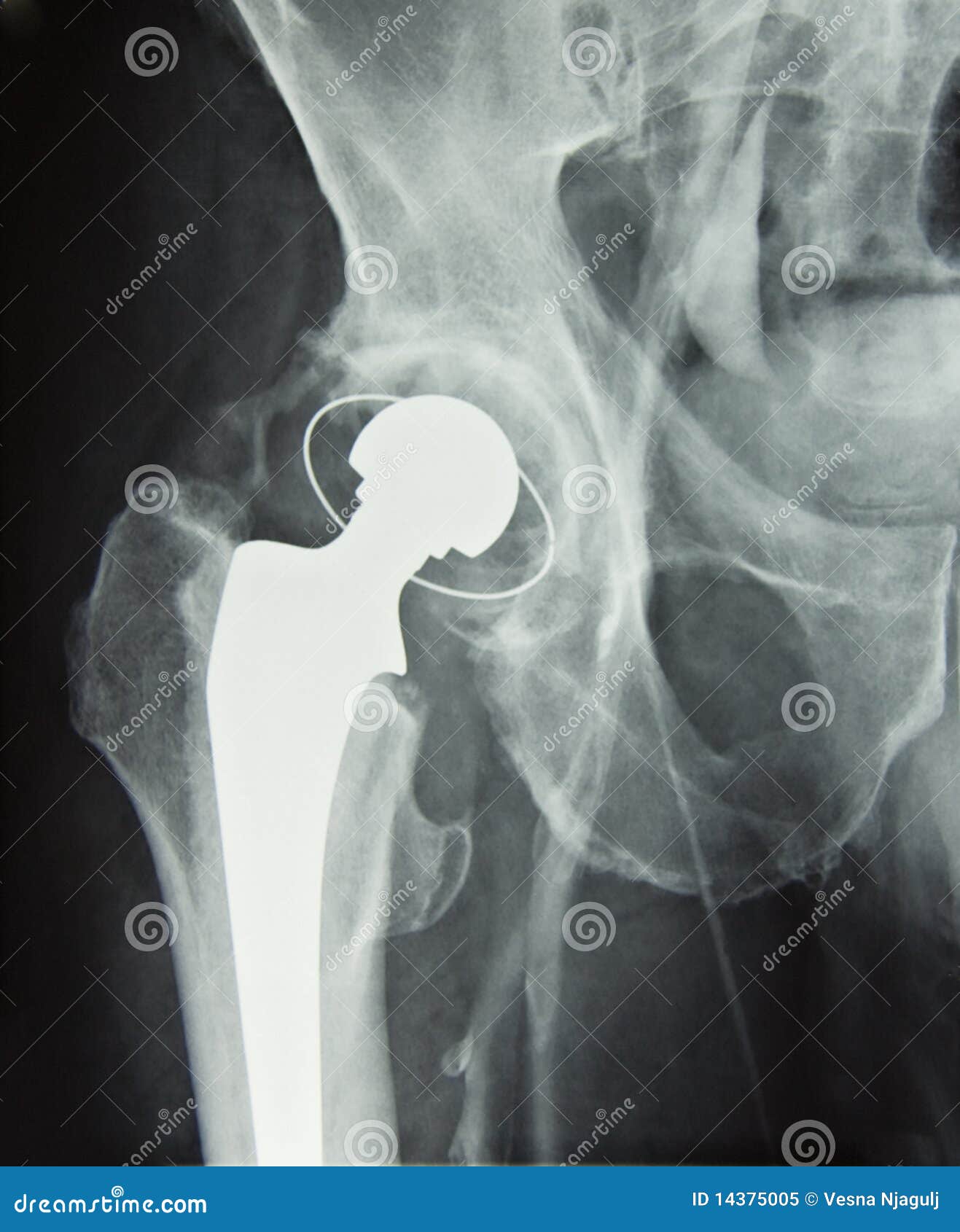 hip prosthesis implant, hip replacement