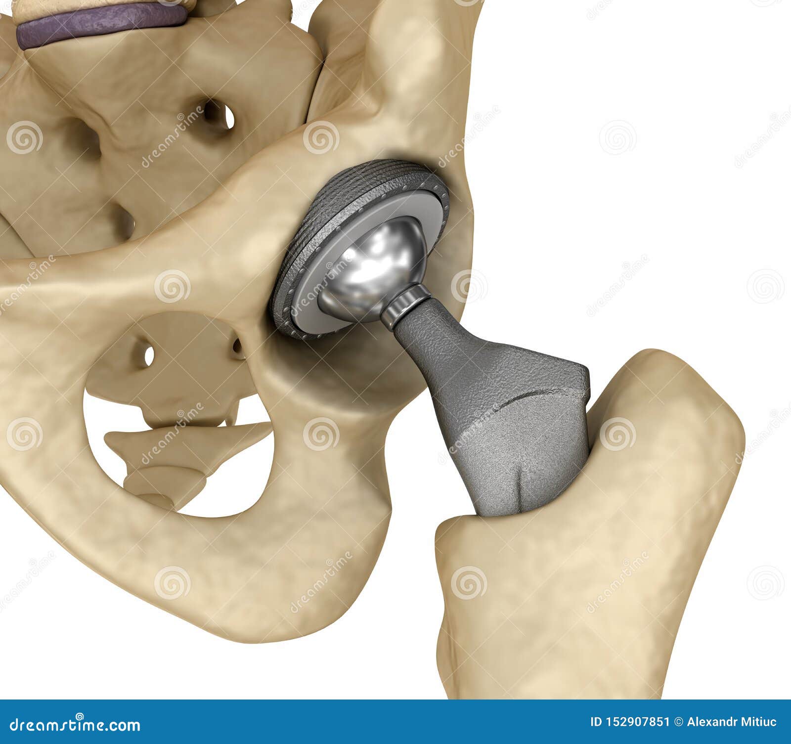 hip replacement implant installed in the pelvis bone