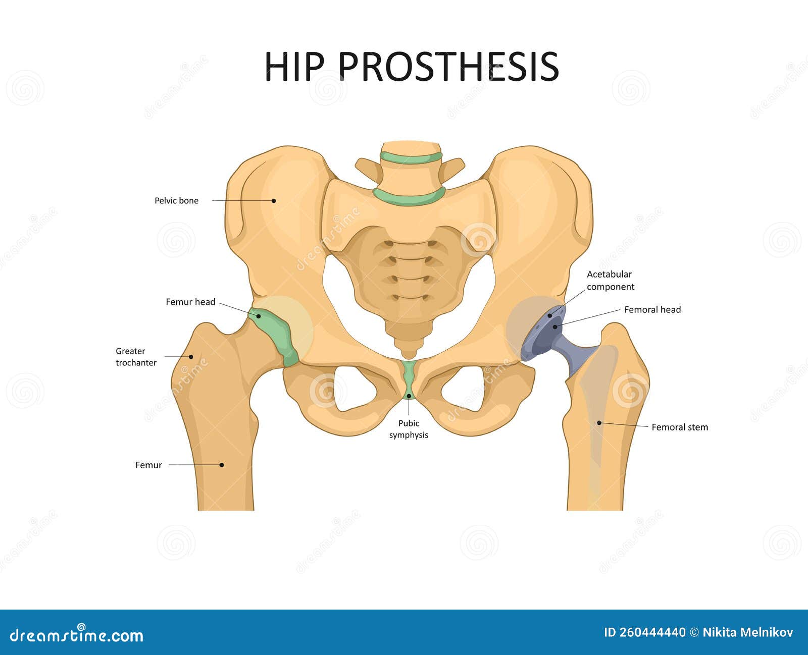 Hip Replacement Implant Installed in the Pelvis Bone. Stock Vector ...