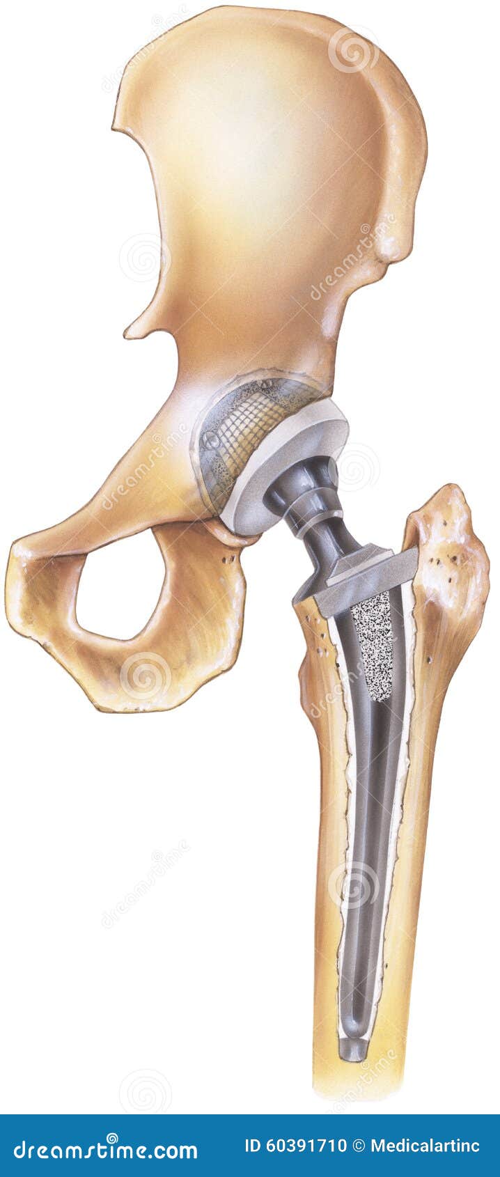 hip - total replacement