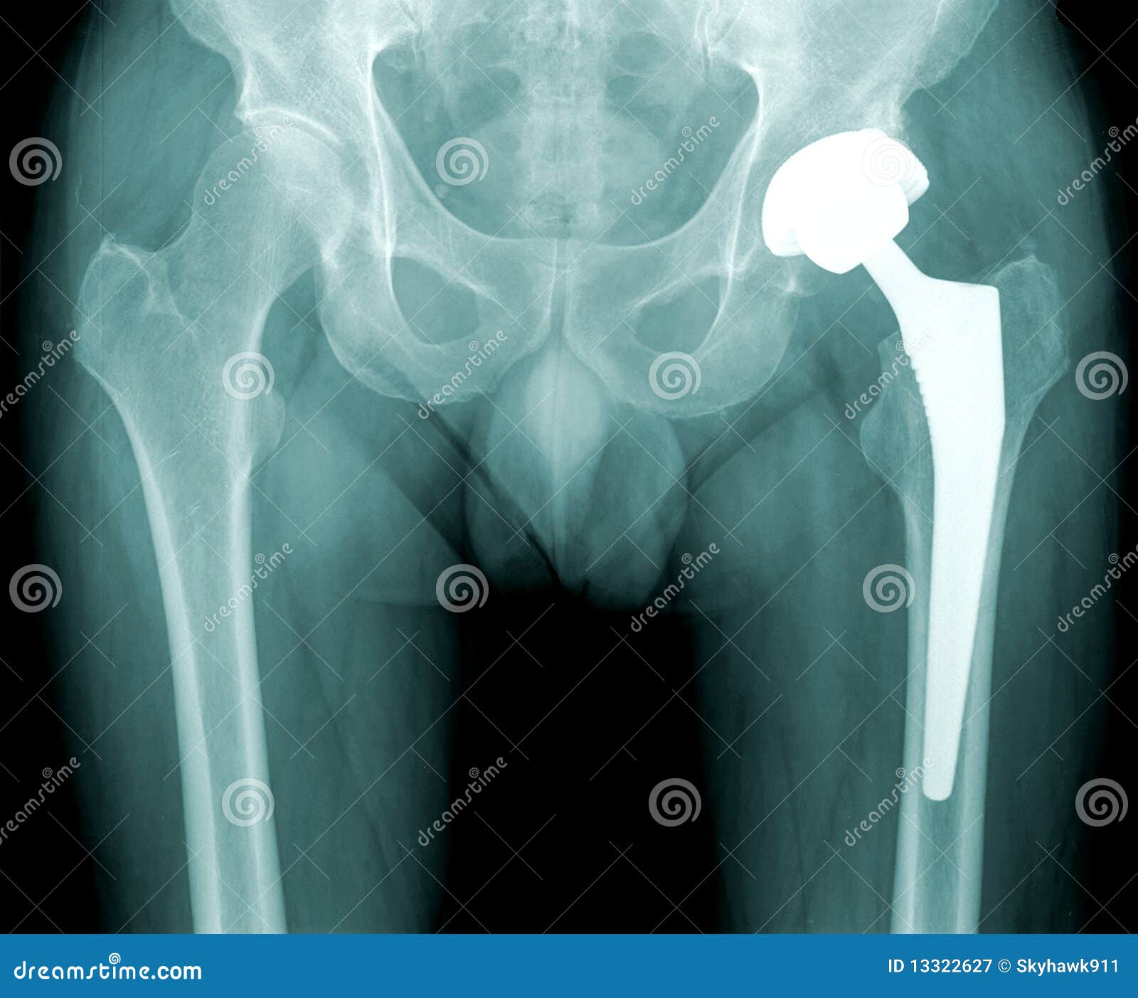 Hip X-ray With Replacement Of The Joint Royalty-Free Stock Photography ...