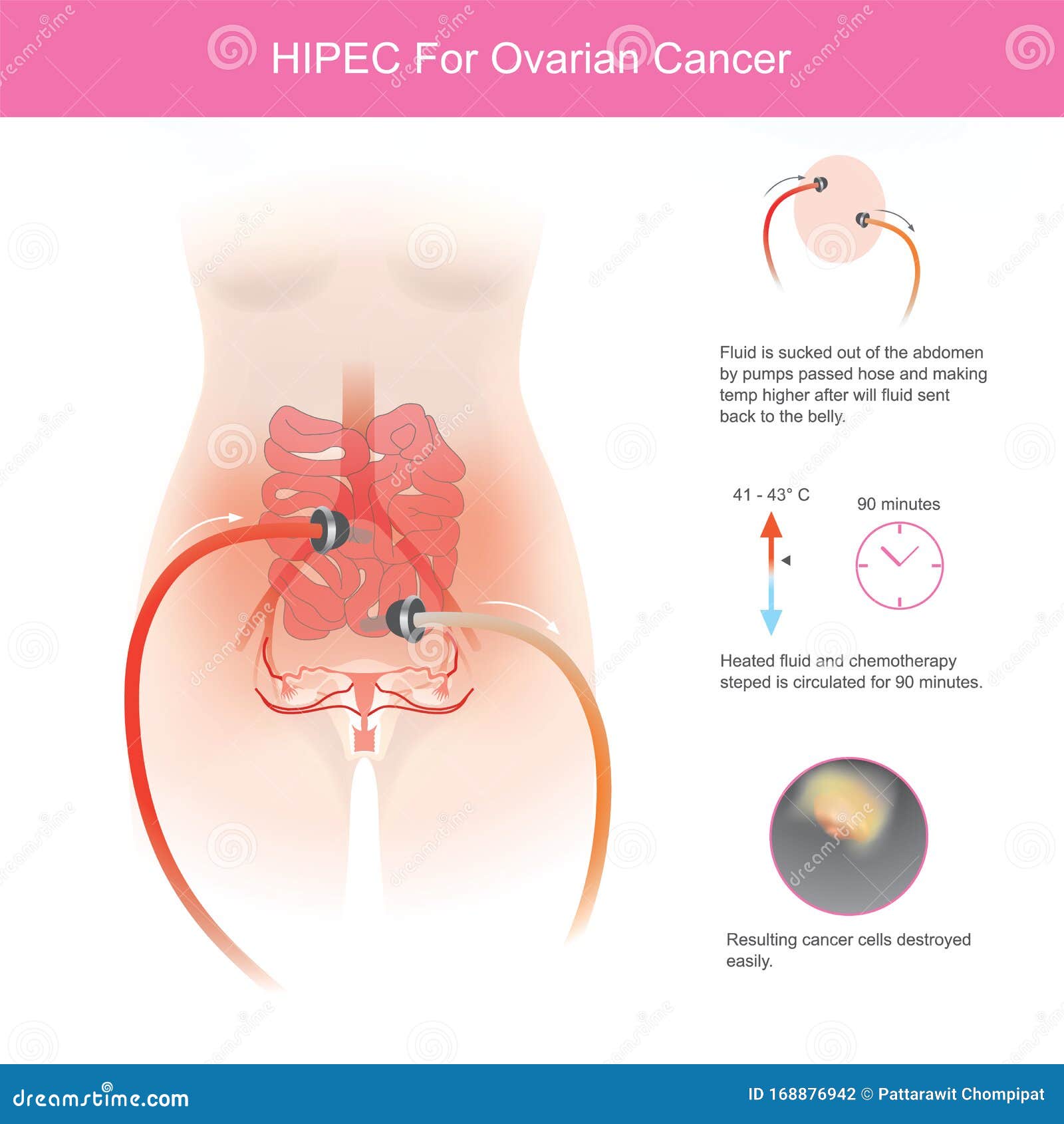 ovarian cancer hipec)