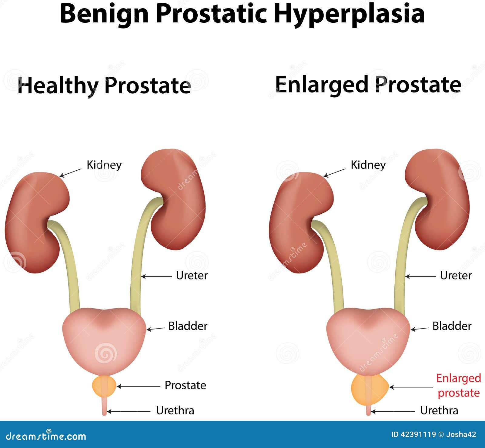 prostatitis és szexlessness