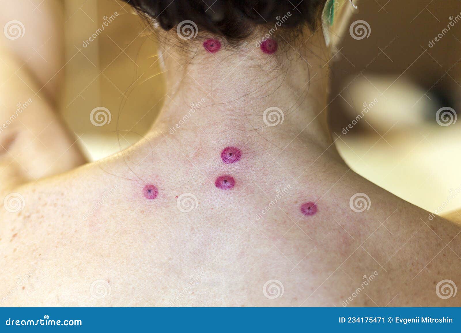 Hirudotherapy, Leech Bite Marks on the Girl`s Back Stock Image