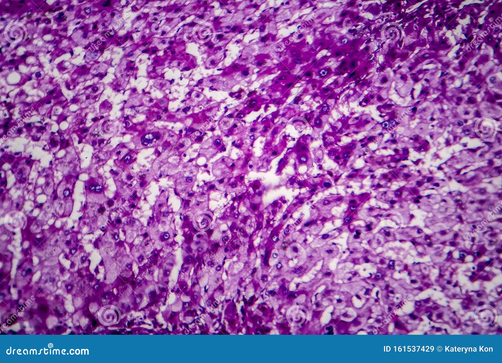Histopathology of Alcoholic Hepatitis Stock Image Image of