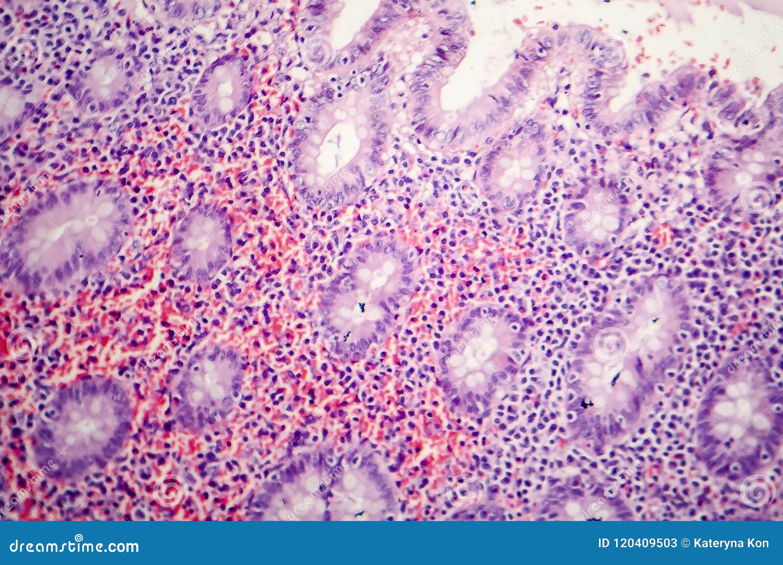 Appendicitis Histology