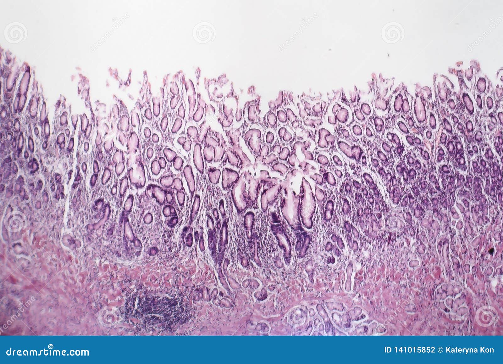 Chronic Atrophic Gastritis, Light Micrograph Stock Photo Image of