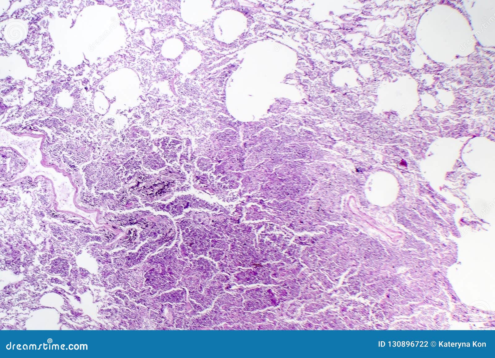 Histopathology of Interstitial Pneumonia Stock Photo Image of micro