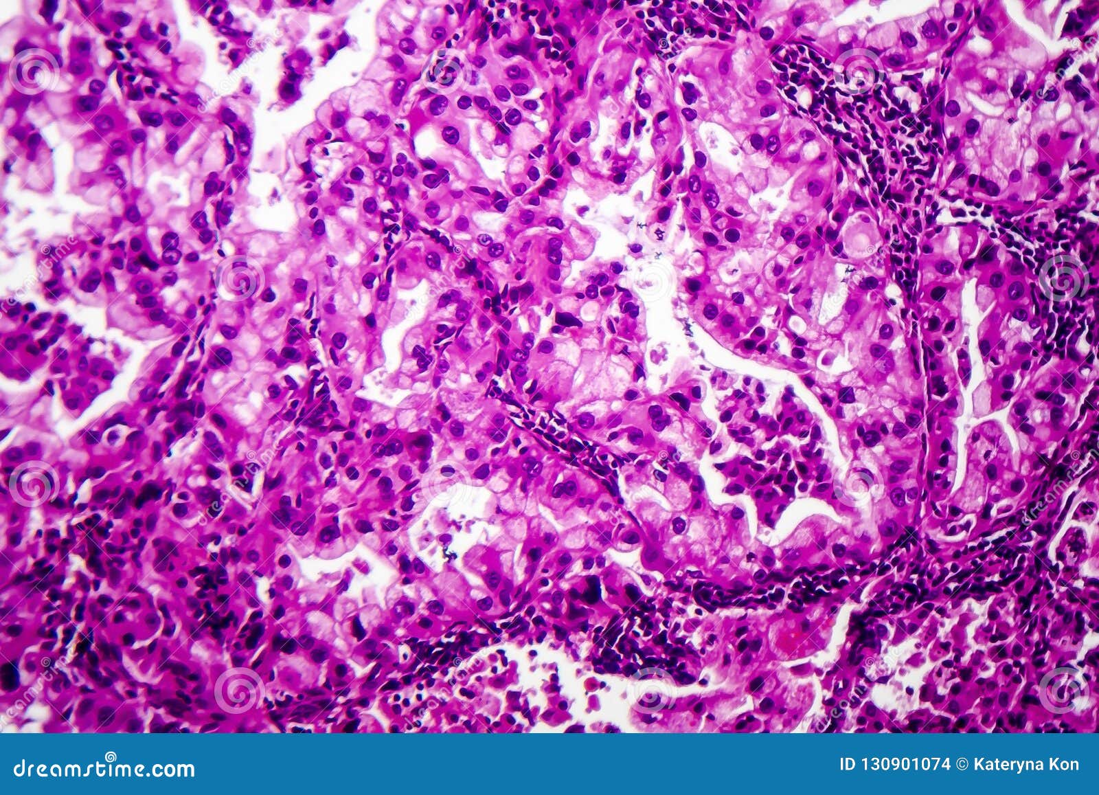 Histopathology Of Lung Cancer Stock Image CartoonDealer 130901317 histopathology-of-lung-cancer-stock-image-cartoondealer-130901317