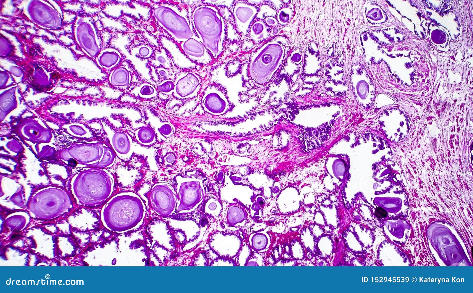 Микроскопическое исследование предстательной железы. Патогистология рисунки. Предстательная железа через микроскоп. Лецитиновые зерна в секрете предстательной железы.