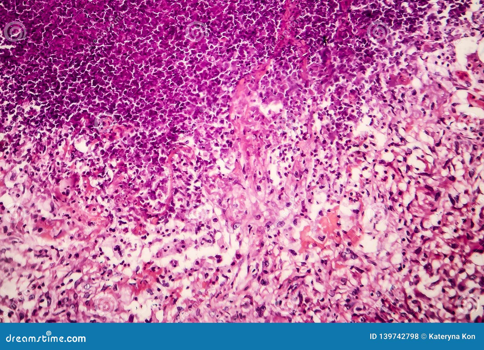 tubercle, light micrograph