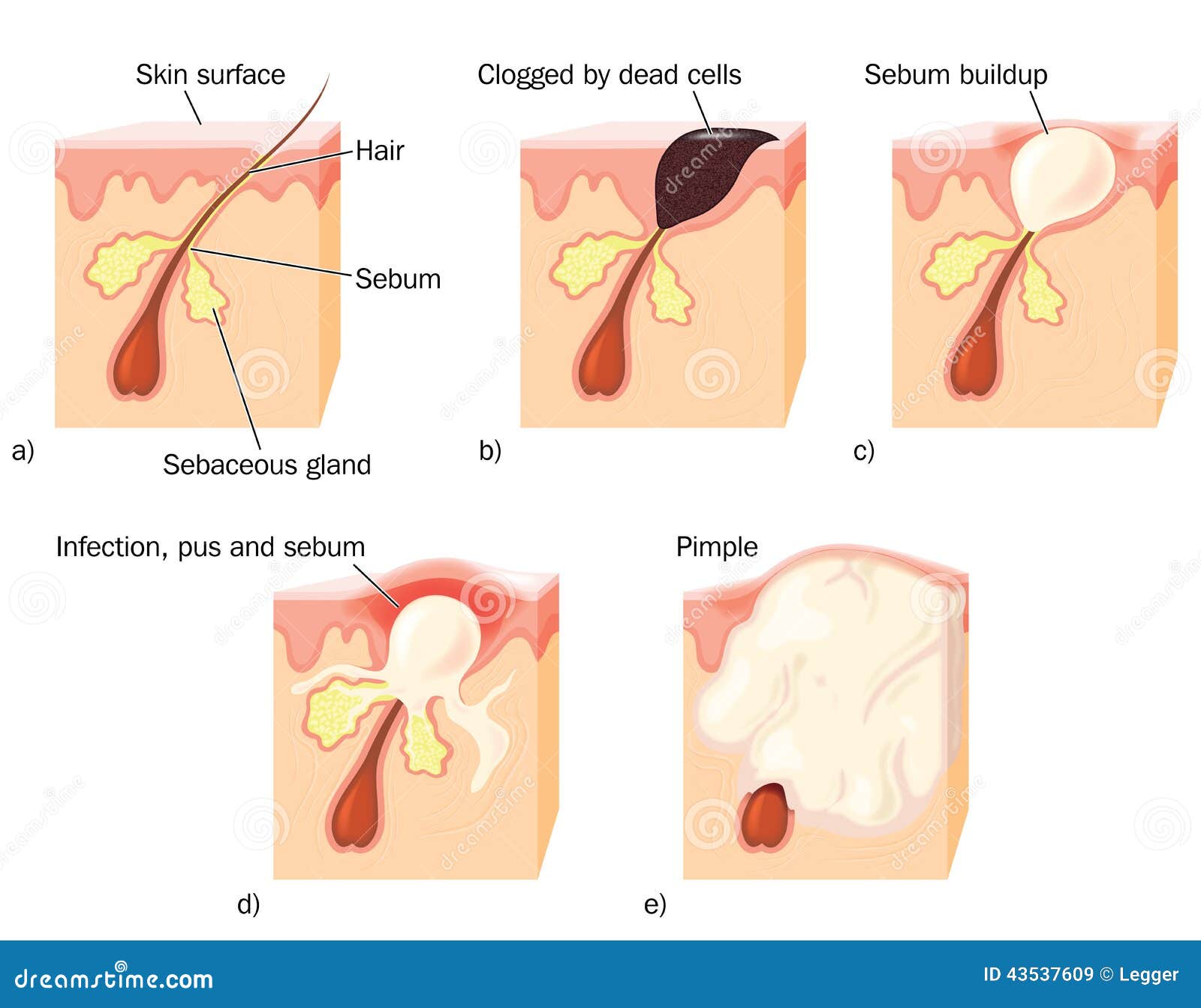 Cyst With Hair And Teeth - Doctor answers on HealthTap