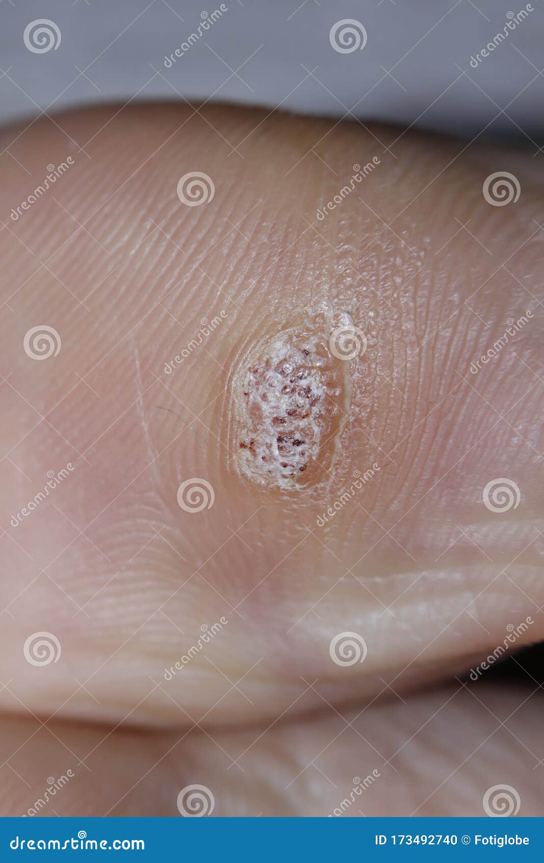 Close Up Shot Of A Plantar Wart On The Bottom Of The Big Toe Caused By