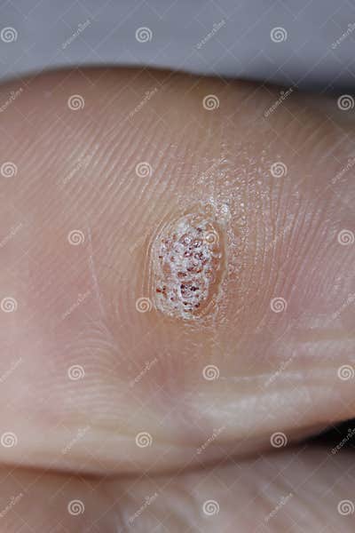 Close Up Shot Of A Plantar Wart On The Bottom Of The Big Toe Caused By