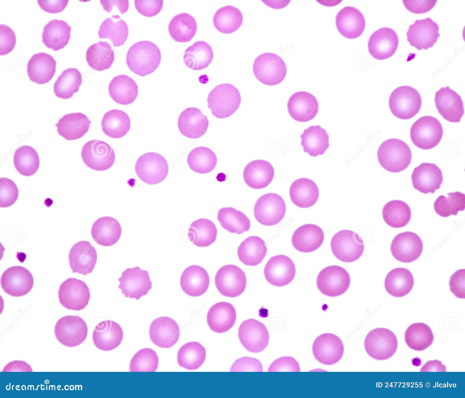 Human Blood Smear. Platelets Stock Image Image of coagulation