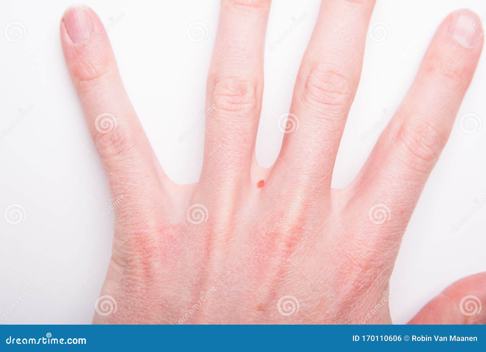 A Human Body with Birthmarks. Stock Photo Image of body