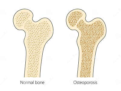Human Bone Structure Osteoporosis Medical Science Stock Illustration ... Biology Diagrams