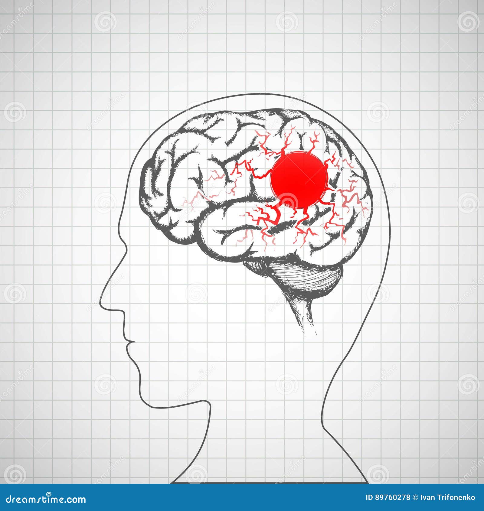 human brain inside the head. migraine disease.