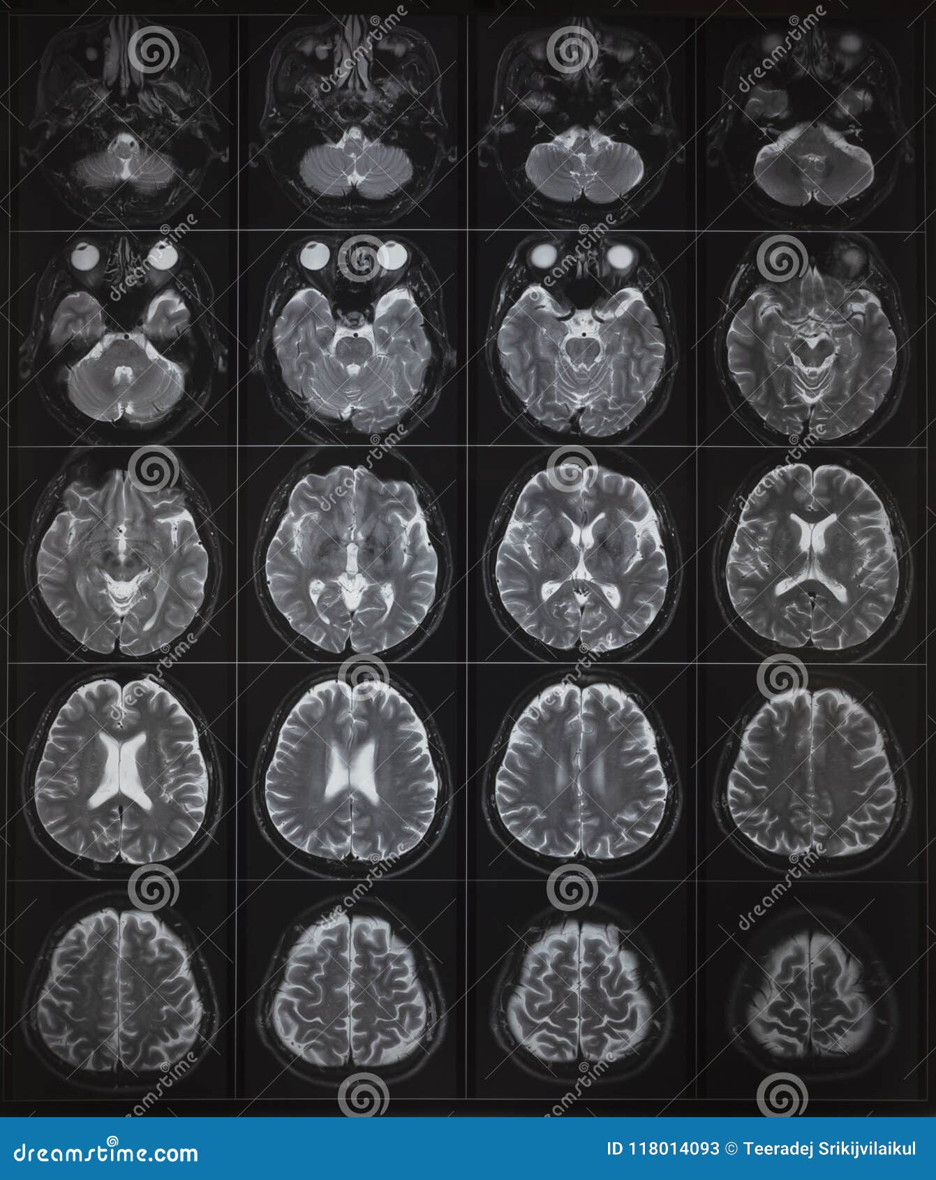 normal brain mri