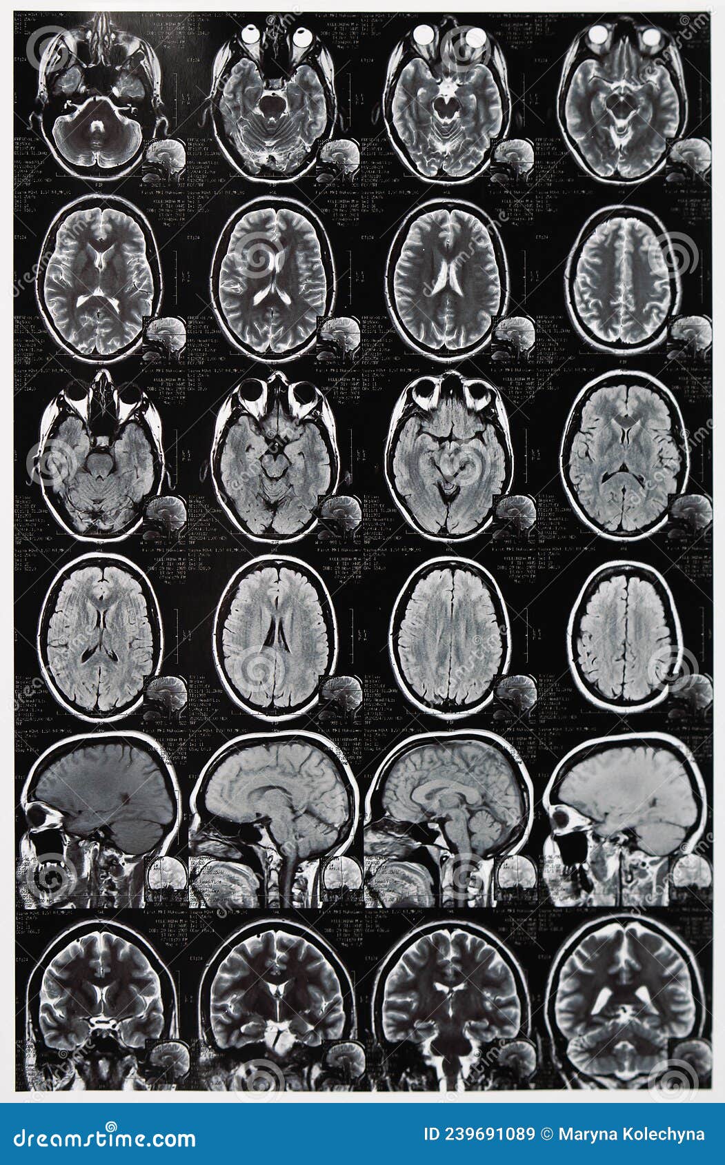 Human Brain MRT Scans. Computer Tomography CT Photos of Human Brain ...