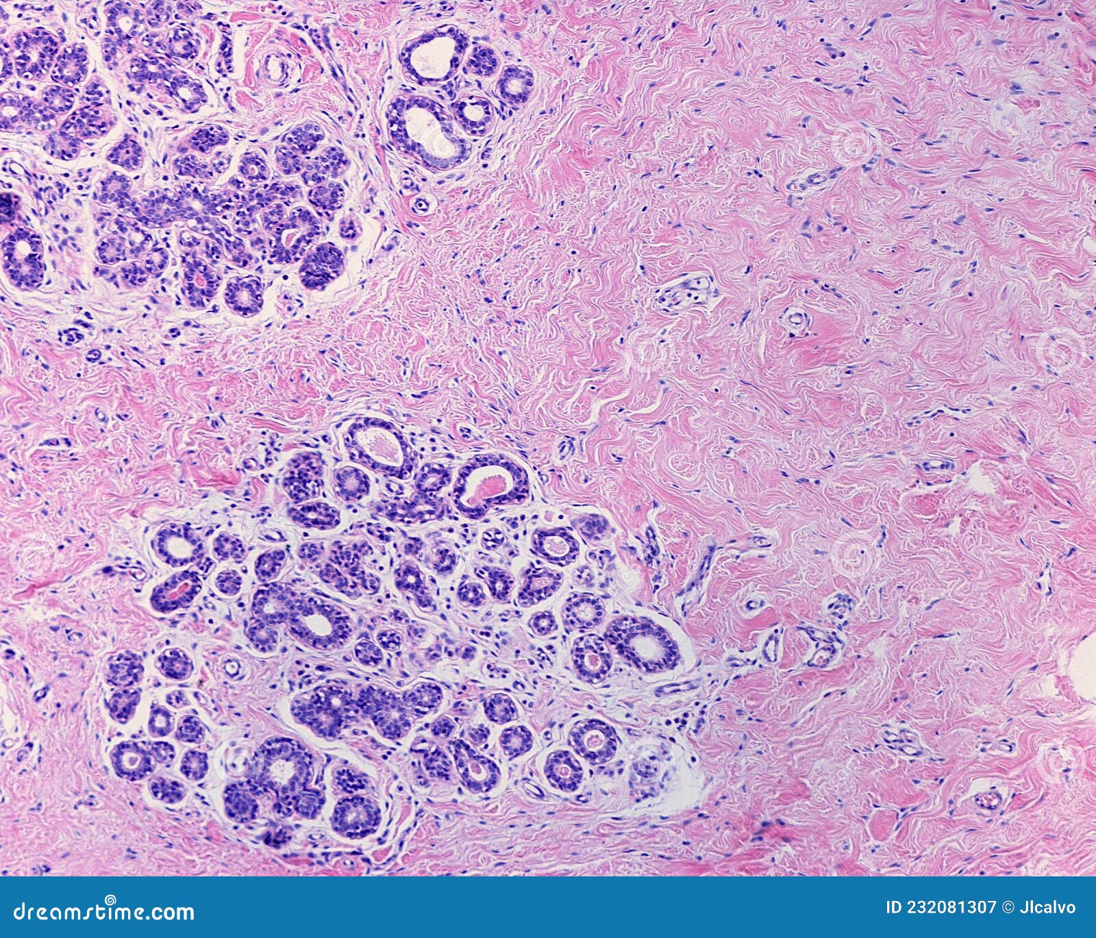 human breast gland. adenosis