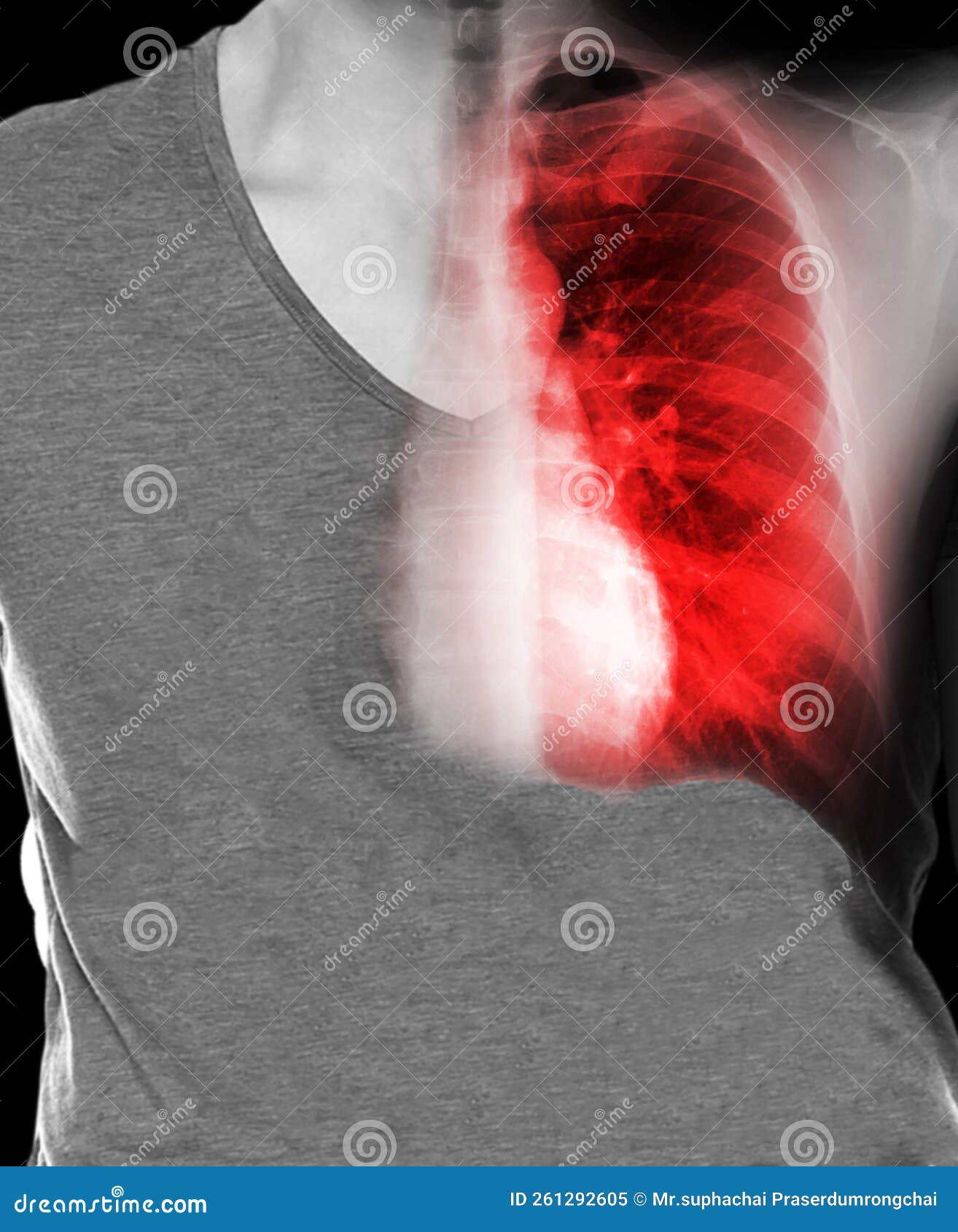 Human Chest With Xray Chest Imaging Stock Photo