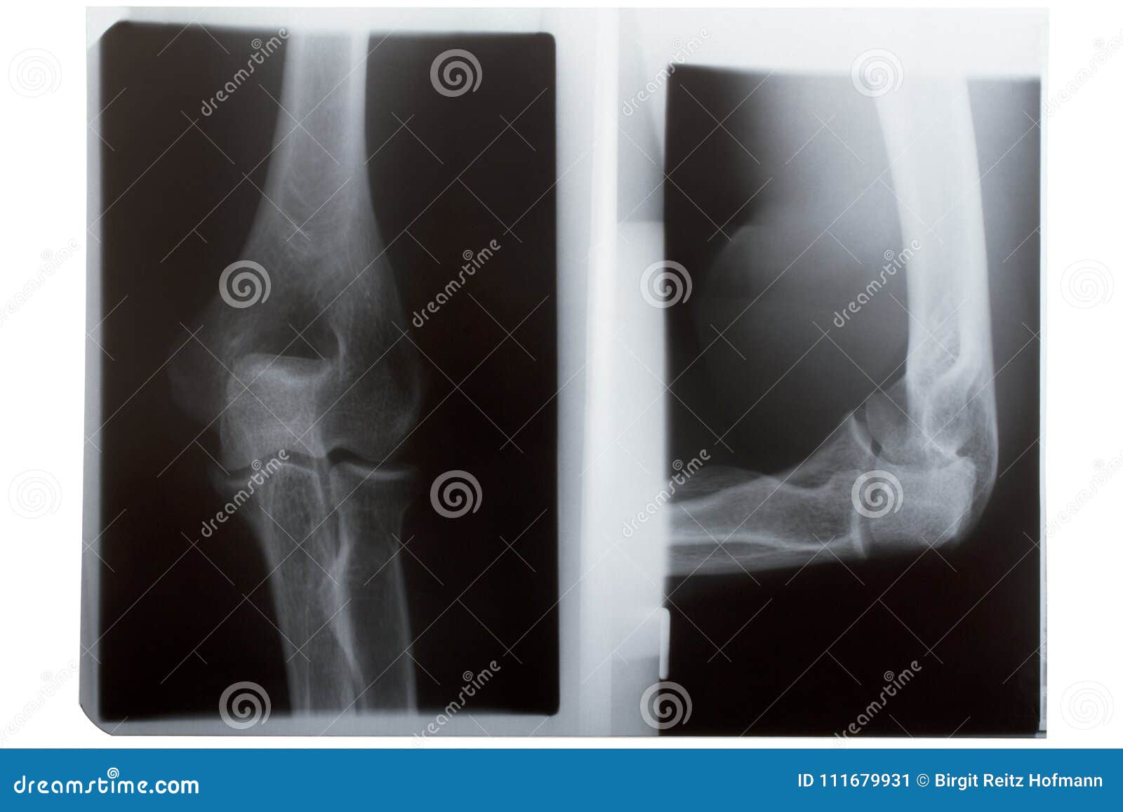 Xray Elbow Or Radiography Of Right Elbow AP And Lateral View Stock