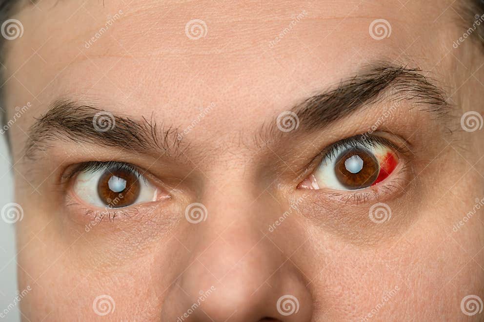 A Human Eye with a Burst Vessel and Blood Leaking into the Eyeball