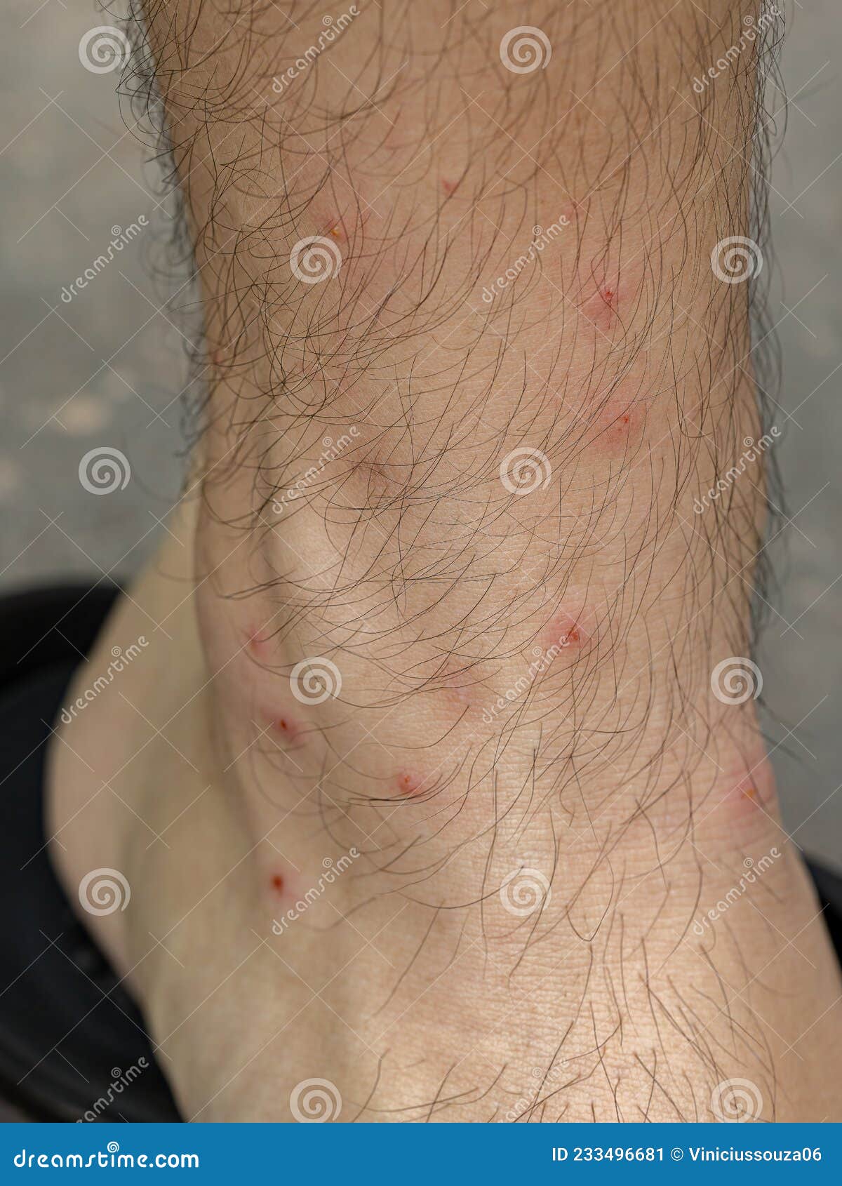 Allergic Reactions To Tick Bites Stock Image Image Of Cajennense