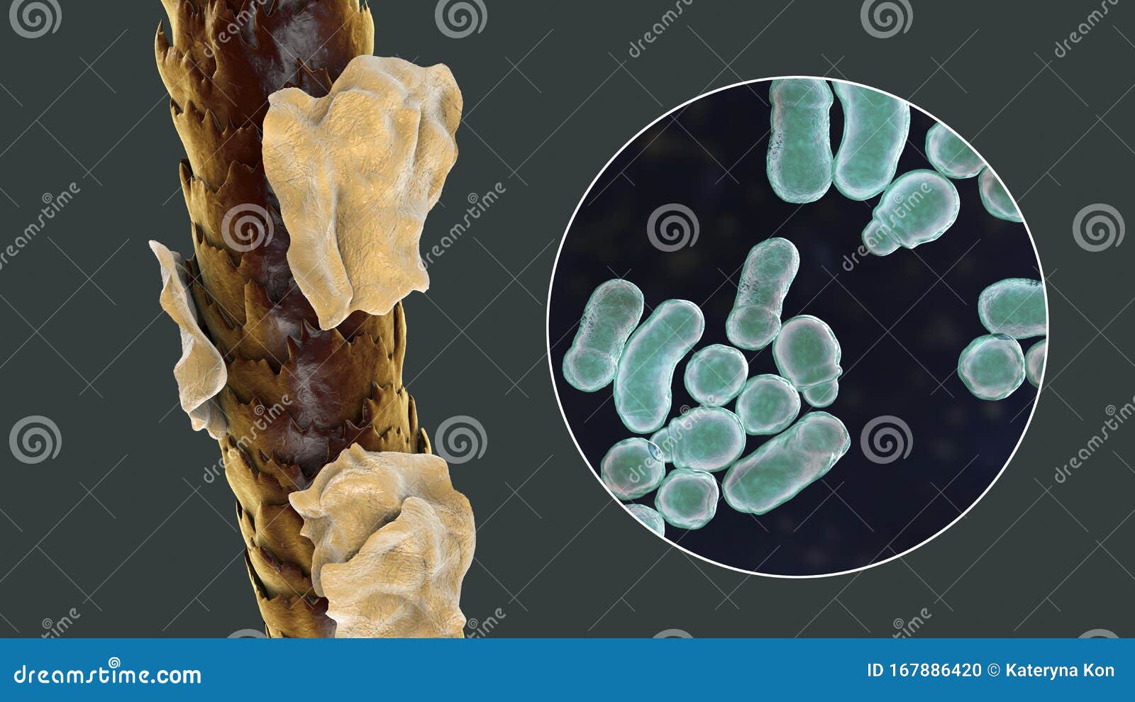 Human Hair with Dandruff and Close-up View of Microscopic Fungi Malassezia  Furfur Stock Illustration - Illustration of science, foot: 167886420