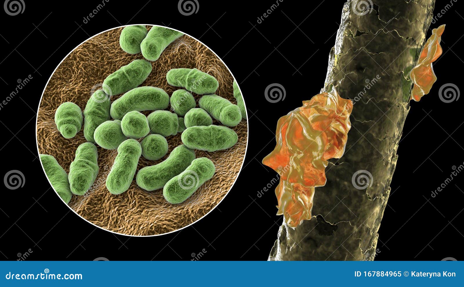 Human Hair with Dandruff and Close-up View of Microscopic Fungi Malassezia  Furfur Stock Illustration - Illustration of microbiology, microorganism:  167884965