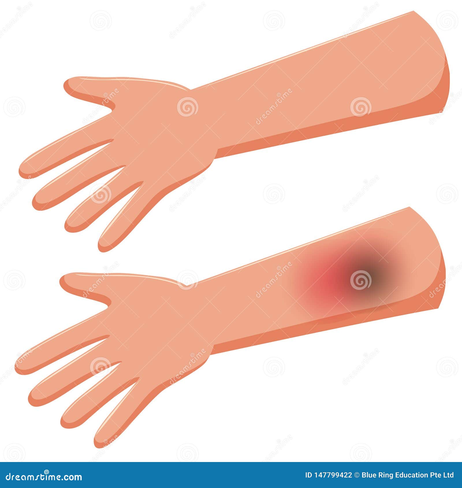 A human hand with bruise stock vector. Illustration of hand 147799422