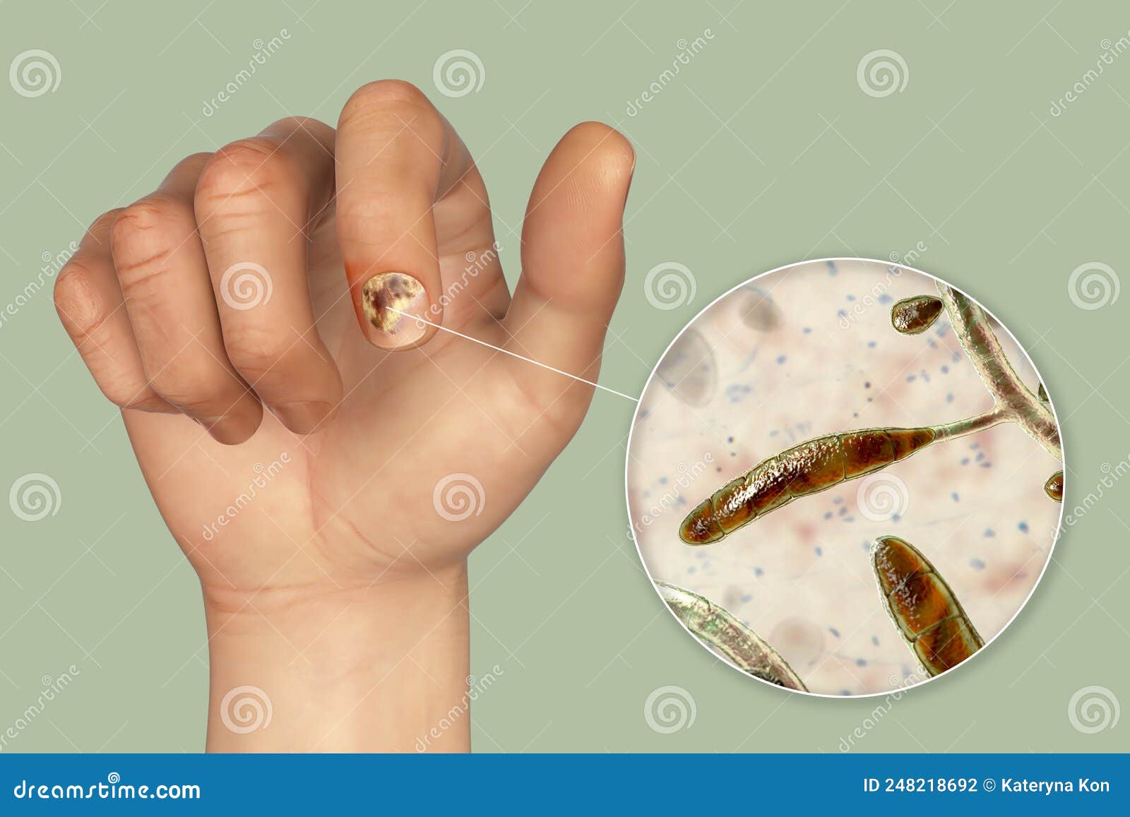 Nail inflammation hi-res stock photography and images - Alamy