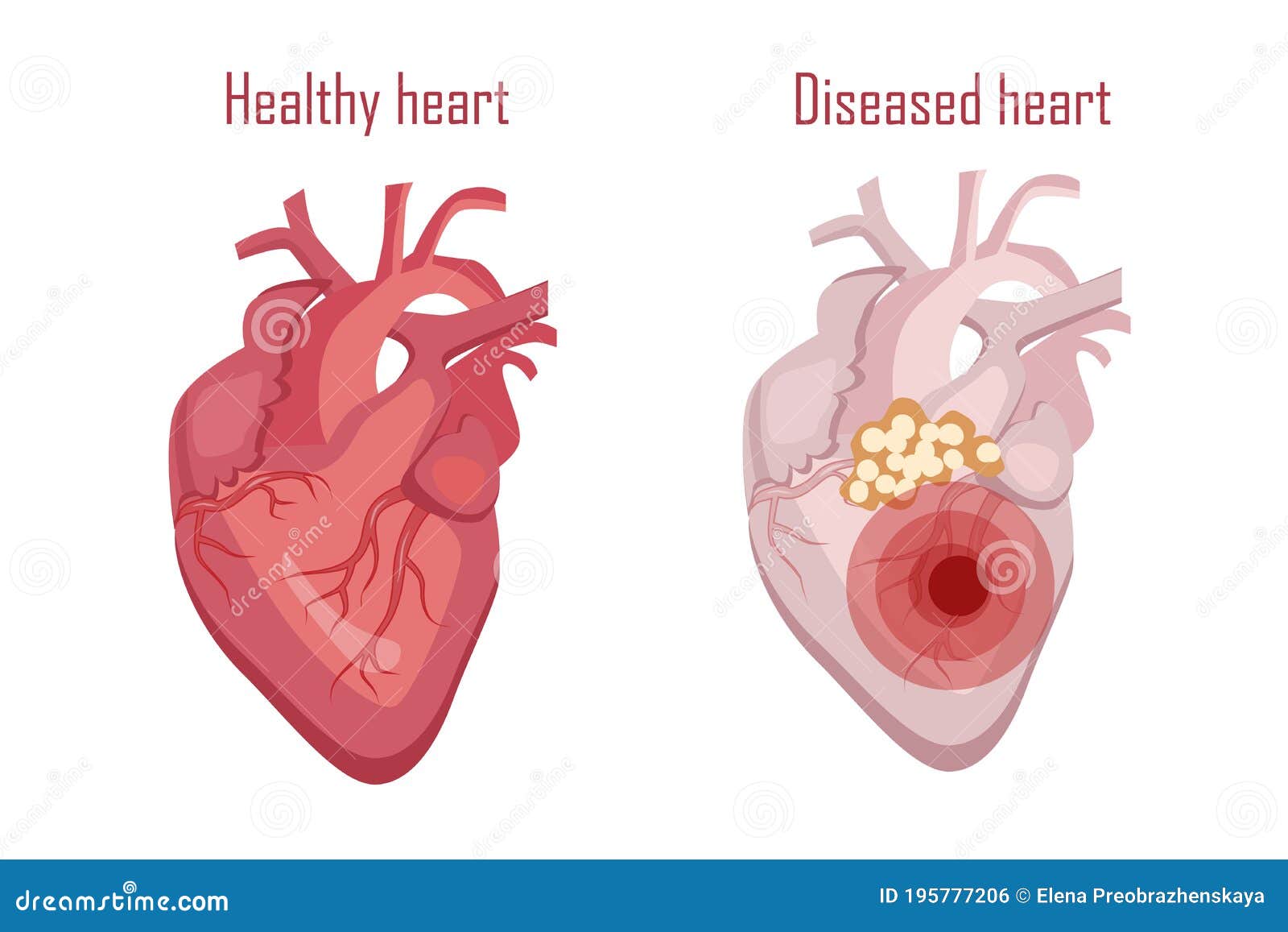 diseased human heart