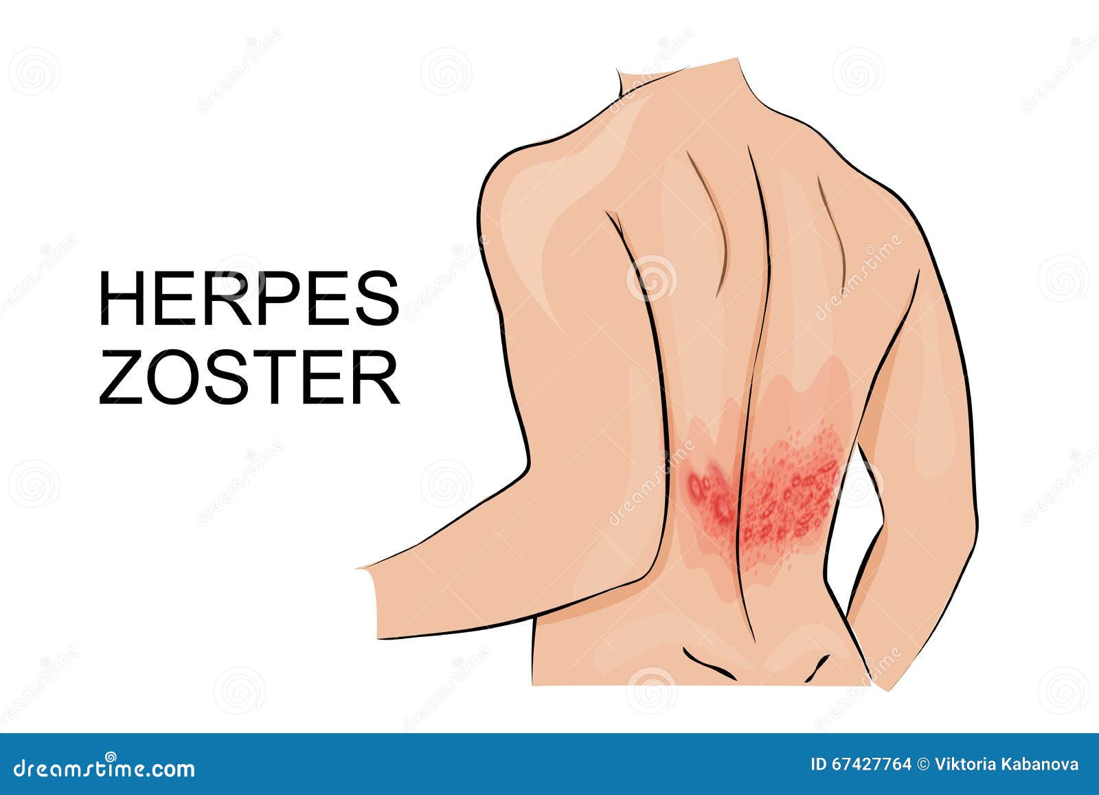 Herpes Pictures HD - Symptoms, Images, Photos and Pictures of Herpes