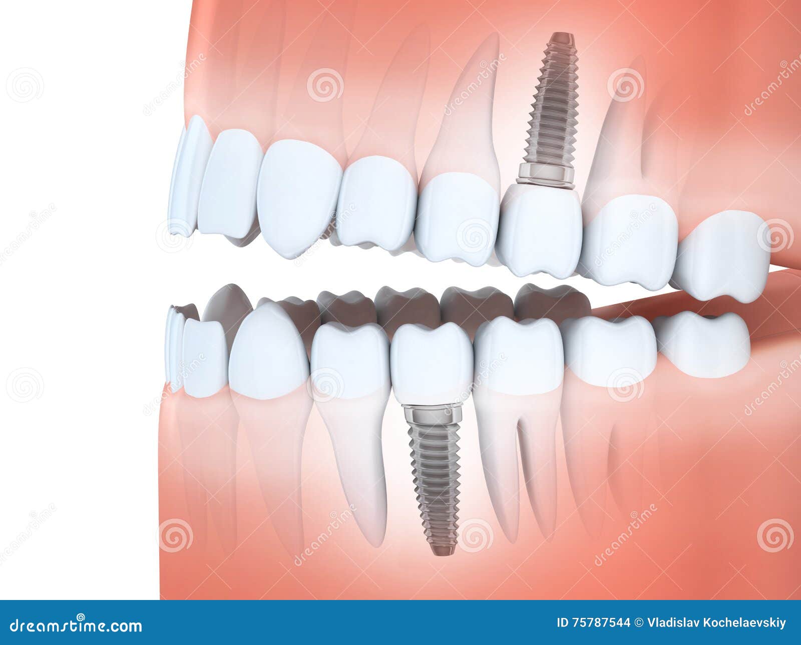 Human Jaw and Dental Implants Stock Illustration Illustration of