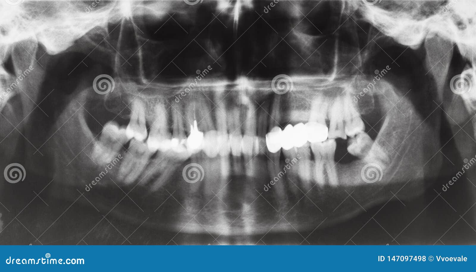 Human Jaws with Dental Crown and Pins in Teeth Stock Photo Image of structure, roentgenography