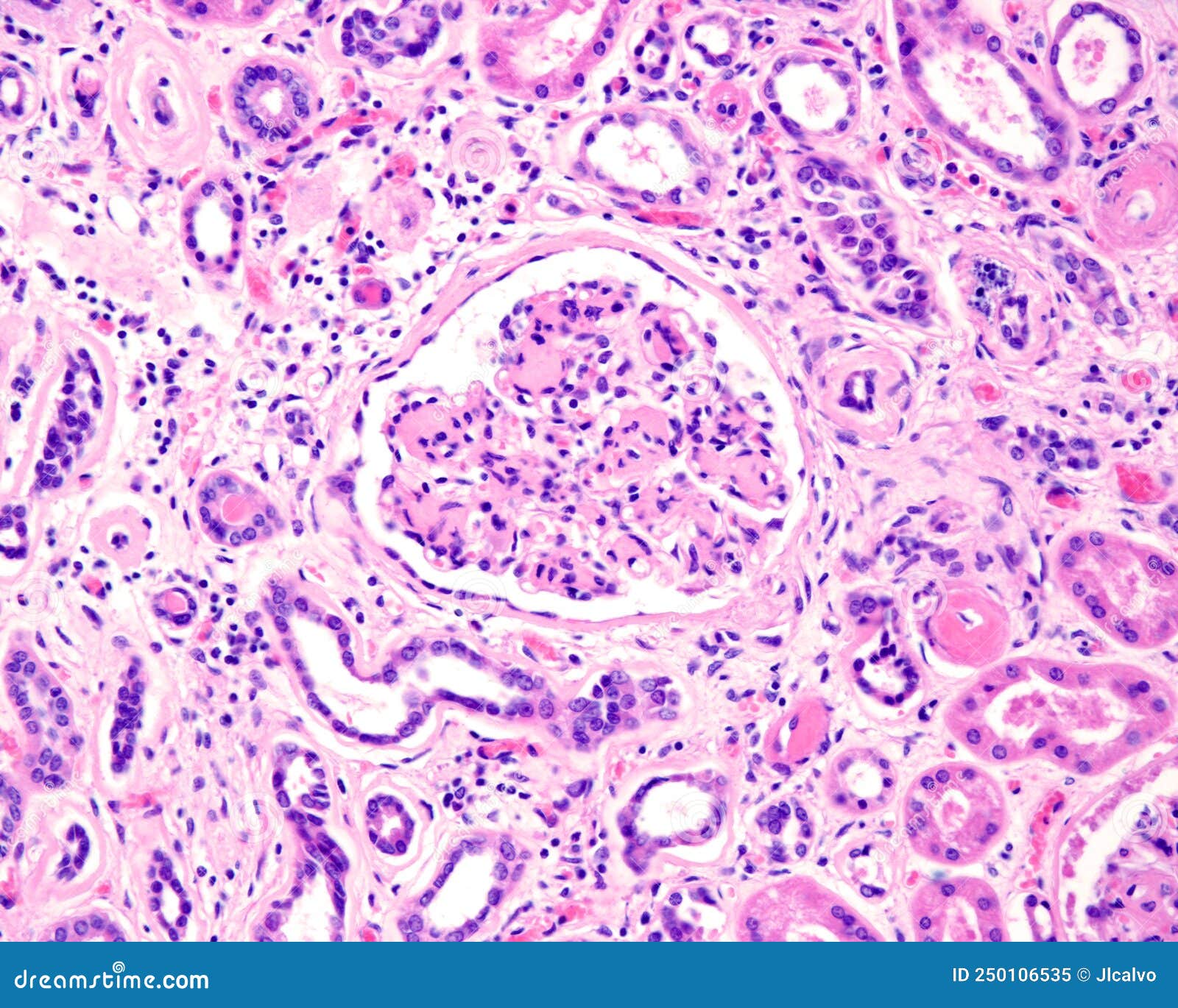 human kidney. diabetic nephropathy