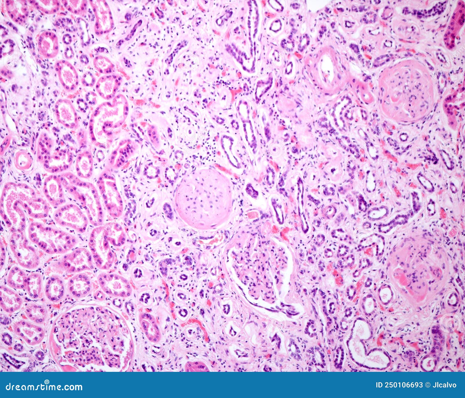 Human Kidney. Diabetic Nephropathy Stock Image - Image of light ...