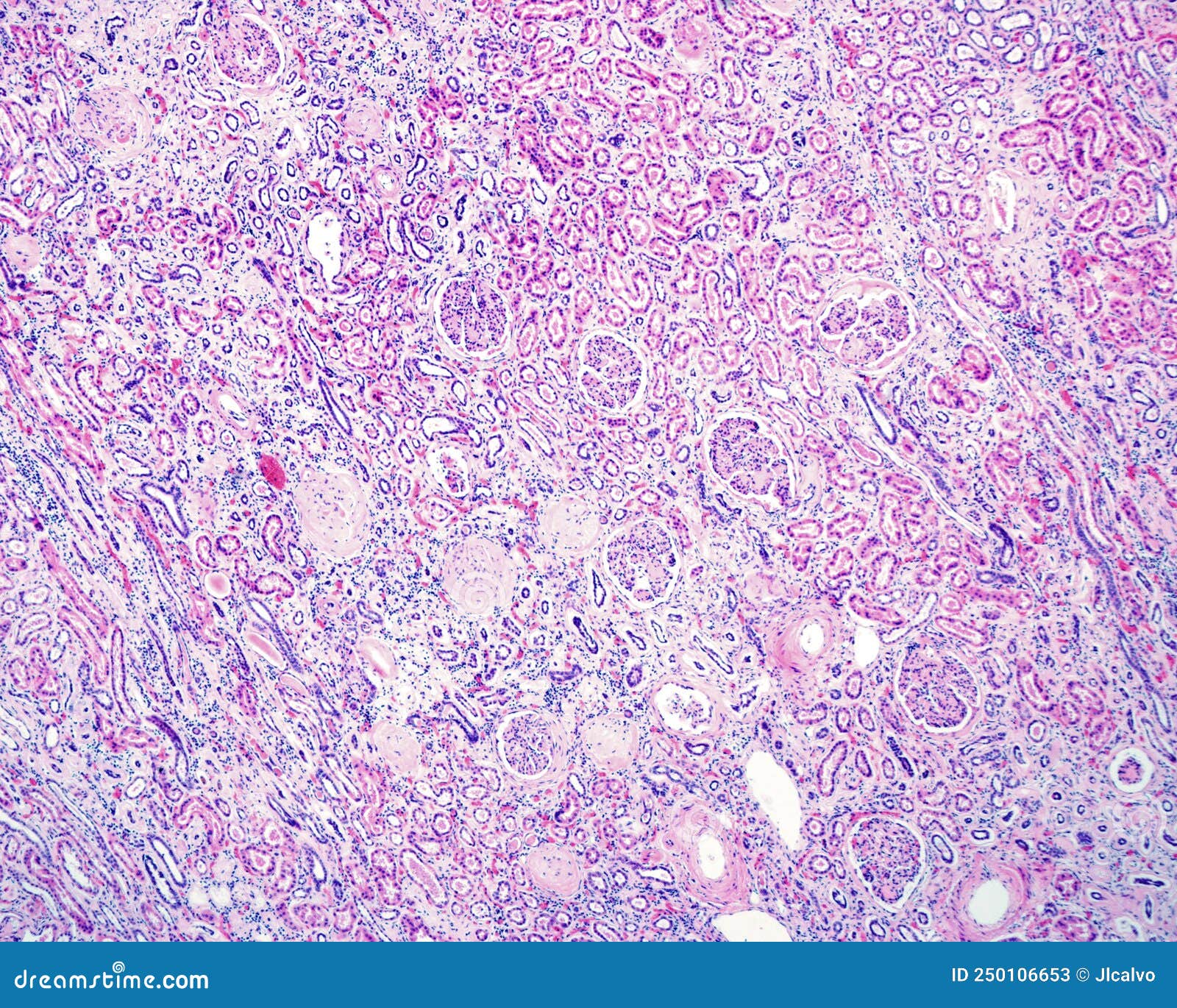 Human Kidney. Diabetic Nephropathy Stock Image - Image of renal ...
