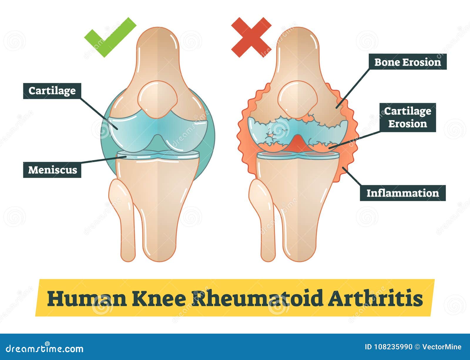 Human Knee Rheumatoid Arthritis, Diagram Illustration Stock Vector