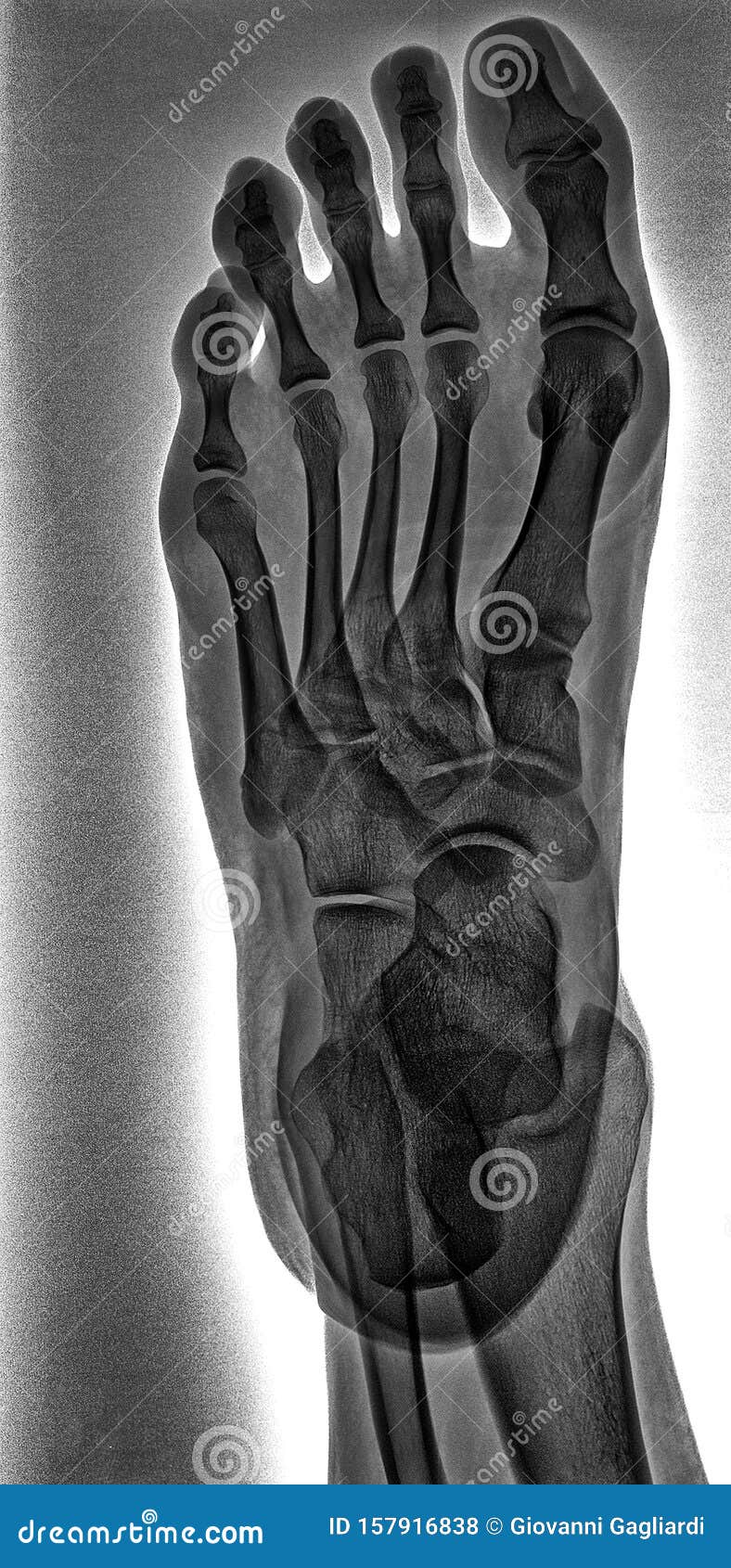 Human Left Foot. X Ray Top View Stock Photo - Image of black, bone