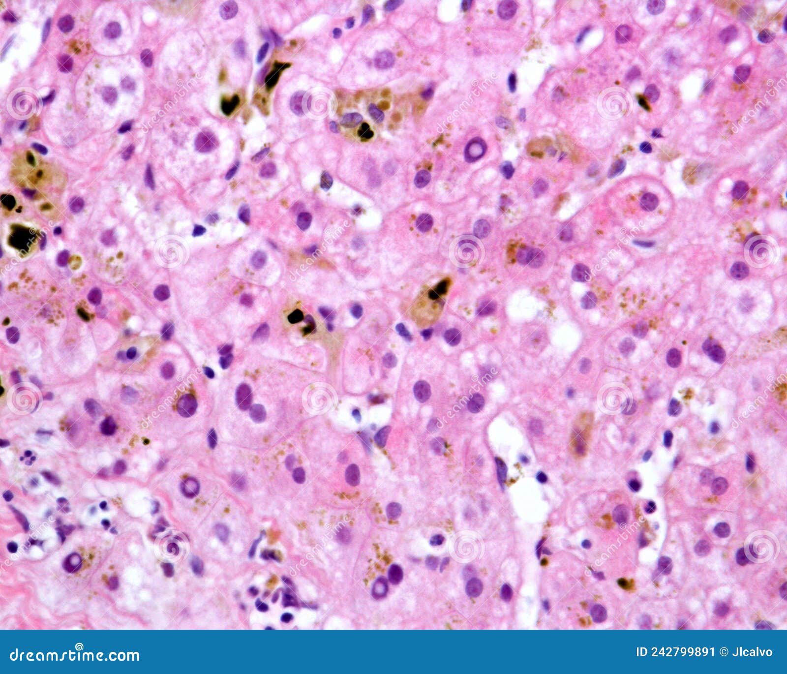 Human liver. Cholestasis stock image. Image of histopathological