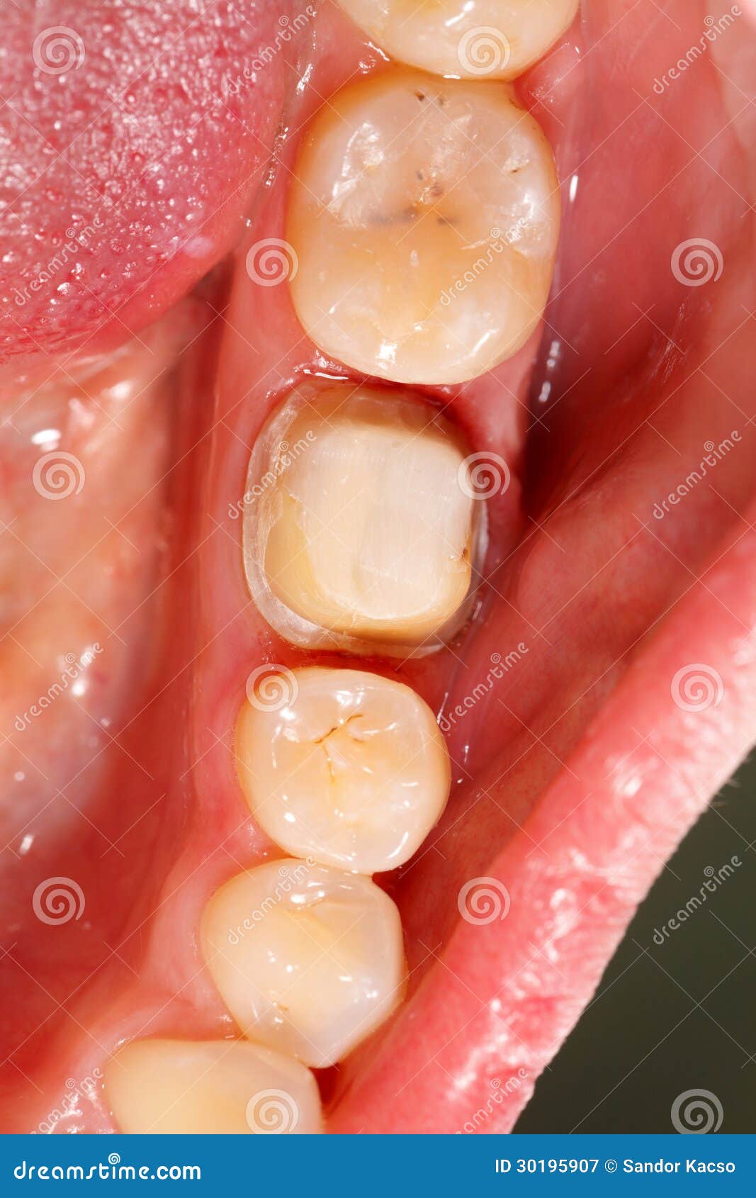 Molar Prepared for Dental Crown Stock Image Image of medical, dentist 30195907